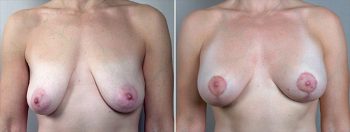 Breast Lift with Implants Patient 13