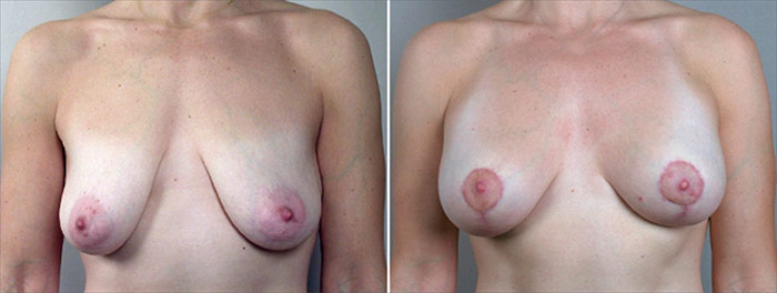 Breast Lift with Implants Patient 13