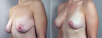 Breast Lift with Implants Patient 13