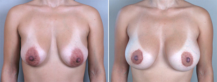 Breast Lift with Implants Patient 1
