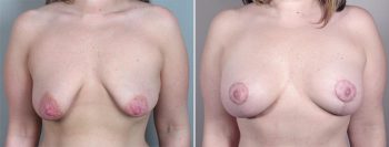 Breast Lift with Implants Patient 8