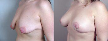 Breast Lift with Implants Patient 8