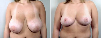 Breast Reduction Patient 7