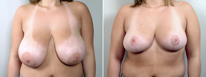 Breast Reduction Patient 7