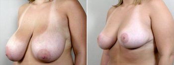 Breast Reduction Patient 7