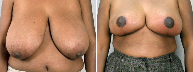 Breast Reduction Patient 22