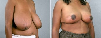 Breast Reduction Patient 22