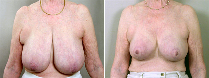 Breast Reduction Patient 8