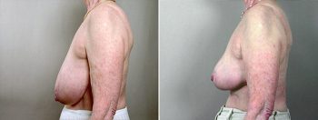 Breast Reduction Patient 8