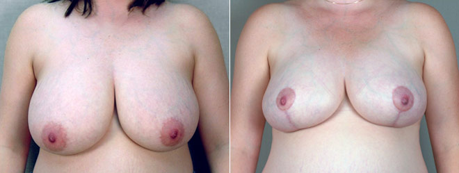 Breast Reduction Patient 23