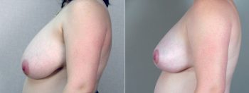 Breast Reduction Patient 23
