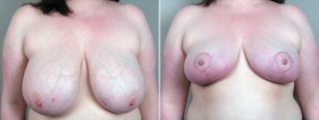 Breast Reduction Patient 24