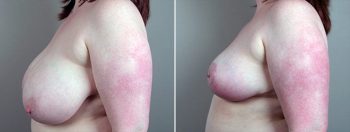 Breast Reduction Patient 24