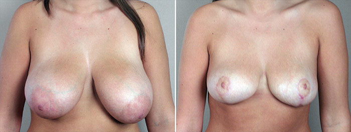 Breast Reduction Patient 9