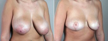 Breast Reduction Patient 9