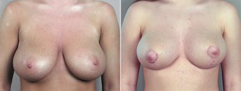 Breast Reduction Patient 10