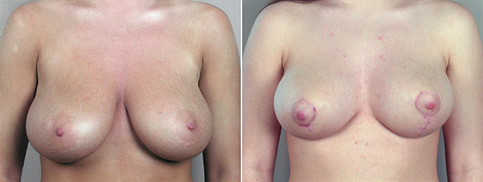 Breast Reduction Patient 10