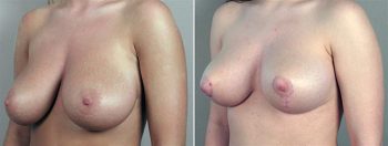 Breast Reduction Patient 10