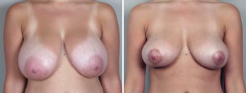 Breast Lift (Vertical Mastopexy Only) Patient 1