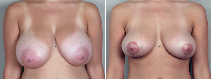 Breast Lift (Vertical Mastopexy Only) Patient 1