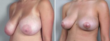 Breast Lift (Vertical Mastopexy Only) Patient 1