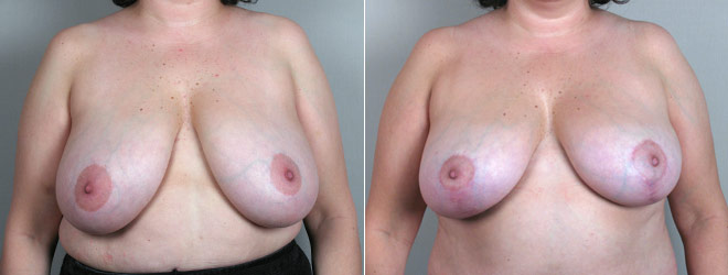Breast Reduction Patient 11