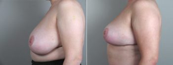 Breast Reduction Patient 11