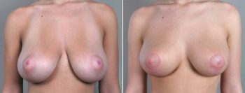 Breast Lift (Vertical Mastopexy Only) Patient 2