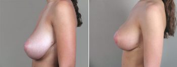 Breast Lift (Vertical Mastopexy Only) Patient 2