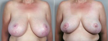 Breast Reduction Patient 20 (Secondary Breast Reduction)