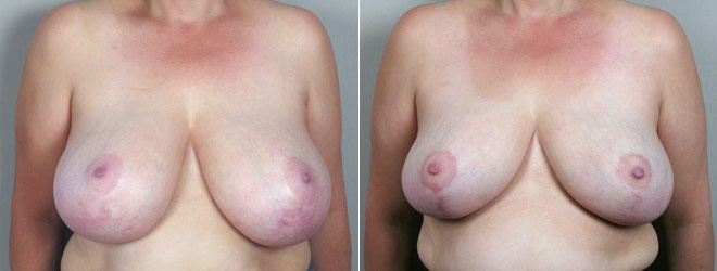 Breast Reduction Patient 20 (Secondary Breast Reduction)
