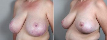 Breast Reduction Patient 20 (Secondary Breast Reduction)