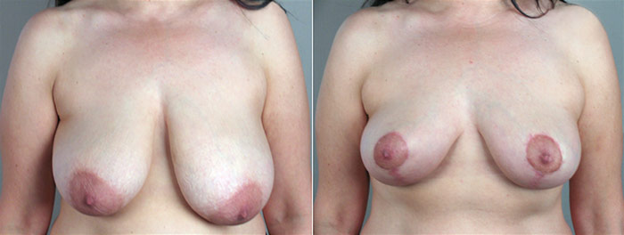 Breast Reduction Patient 3