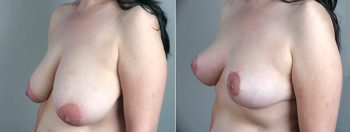Breast Reduction Patient 3