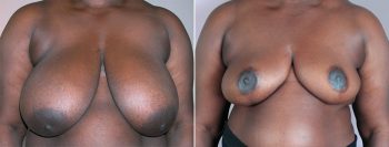Breast Reduction Patient 17