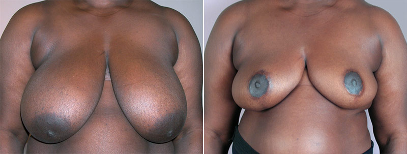 Breast Reduction Patient 17