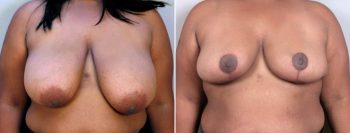 Breast Reduction Patient 16