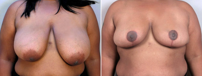 Breast Reduction Patient 16