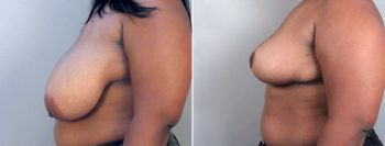 Breast Reduction Patient 16