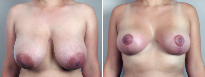 Breast Reduction Patient 5