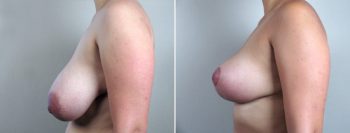 Breast Reduction Patient 5