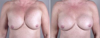 Removal & Replacement of Implants Patient 10