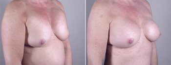 Removal & Replacement of Implants Patient 10