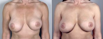 Removal & Replacement of Implants Patient 12