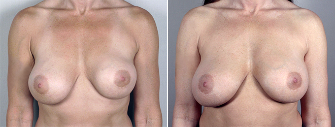 Removal & Replacement of Implants Patient 12