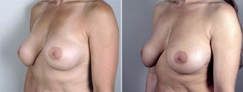 Removal & Replacement of Implants Patient 12