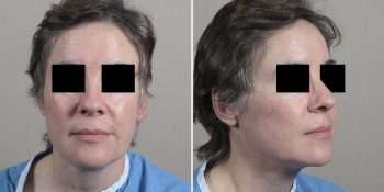 Face Lift Patient 18