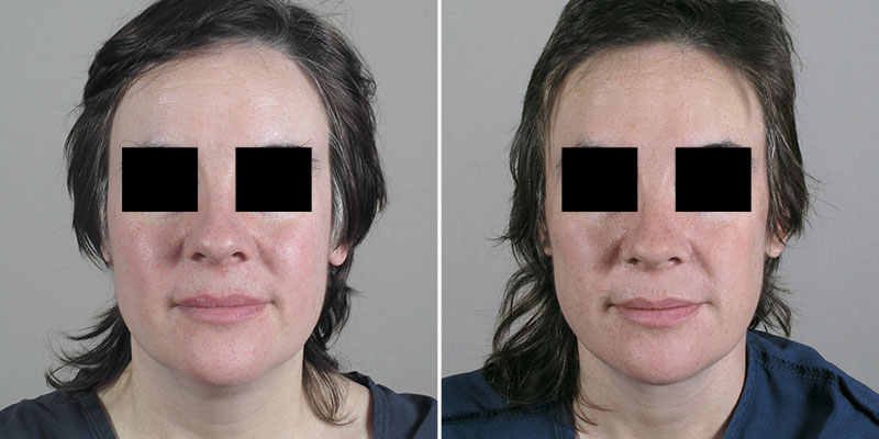 Face Lift Patient 18