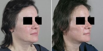 Face Lift Patient 18