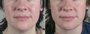 Face Lift Patient 18